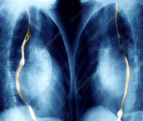Enlarged Heart X Rays Stock Image M1720597 Science Photo Library