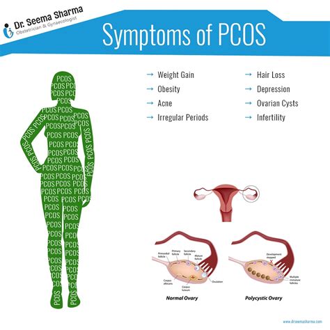 Symptoms Of Pcos Dr Seema Sharma