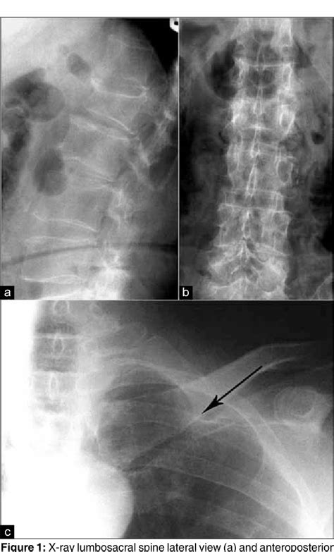 Figure 1 From Nonsecretory Multiple Myeloma Semantic Scholar