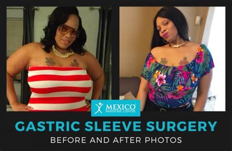 Gastric Sleeve Before And After Photos The Best Pictures Of 2022