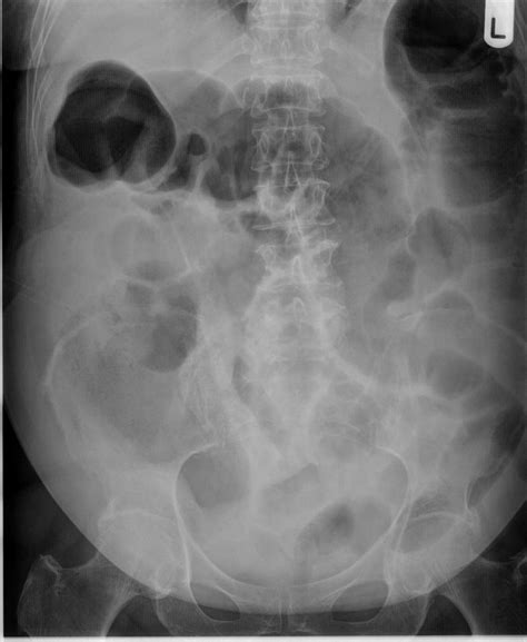 Intestinal Obstruction X Ray Approach To The Abdominal X Ray Axr