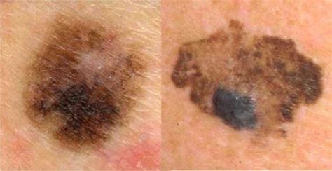 Does Skin Cancer Itch Cancer Blog