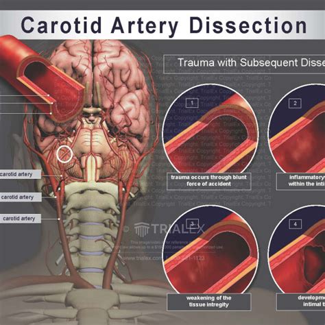Carotid Artery Dissection Trialexhibits Inc Free Hot Nude Porn Pic