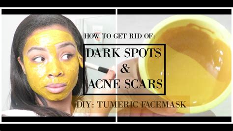 How To Get Rid Of Acne Scars And Dark Spots Diy Tumeric Facemask Youtube