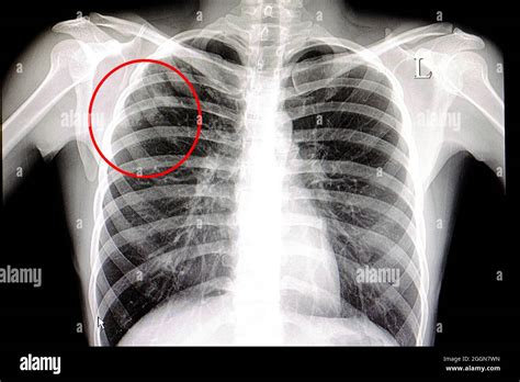 Tuberculosis Lung X Ray