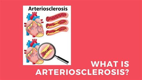 What Is Arteriosclerosis Signs Causes Symptoms And How To Treat 2024