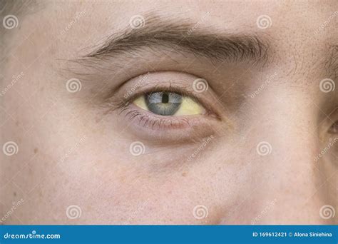 The Yellow Color Of The Male Eye Symptom Of Jaundice Hepatitis Or