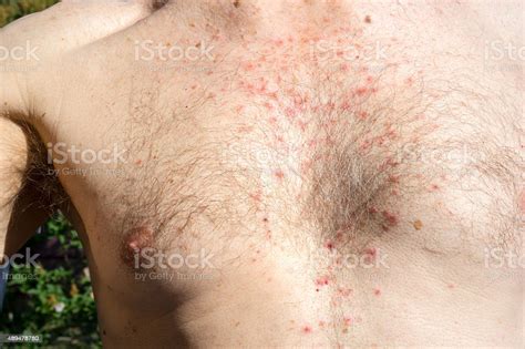 Chest Skin Rash As Drug Side Effect After Surgery Stock Photo