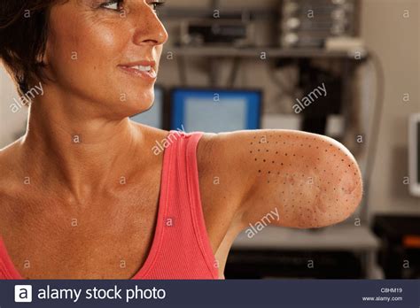 Woman Amputee Arm Stock Photos And Woman Amputee Arm Stock Images Alamy