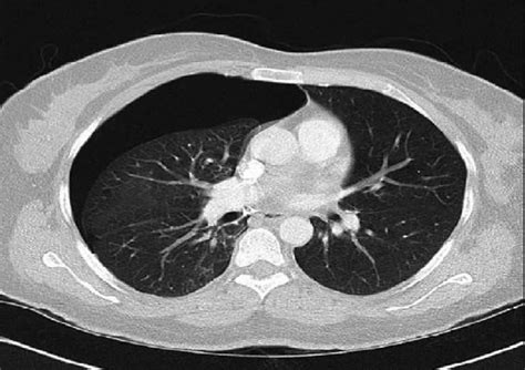 Pneumothorax is the presence of air between the parietal and visceral pleura in the pleural cavity. Chest CT revealed right-sided pneumothorax without any ...