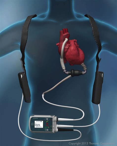 Mechanical Circulatory Support Devices Intechopen
