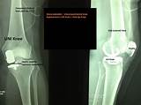 Photos of Bilateral Partial Knee Replacement Recovery Time