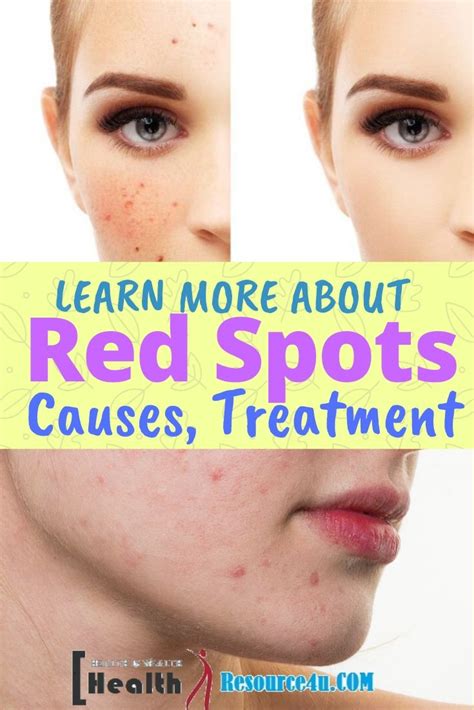 Red Spots On The Skin Symptoms Causes And Home Treatment
