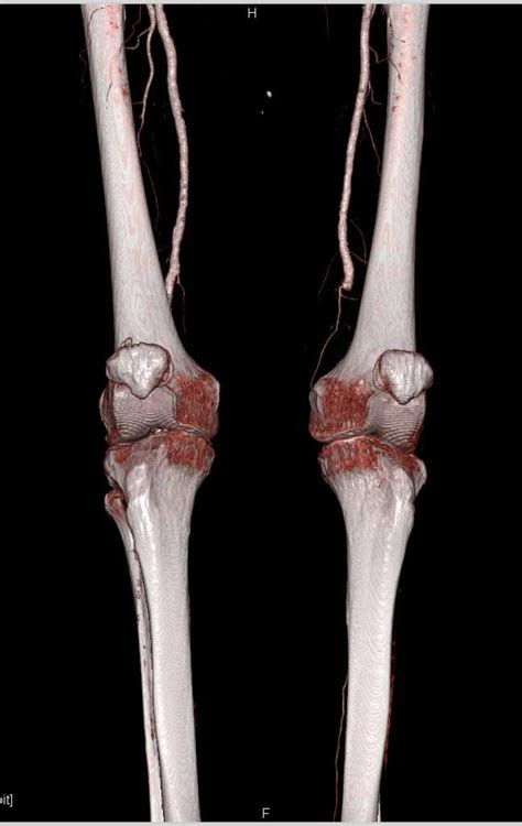 Peripheral Vascular Disease Pvd With Left Superficial Femoral Artery