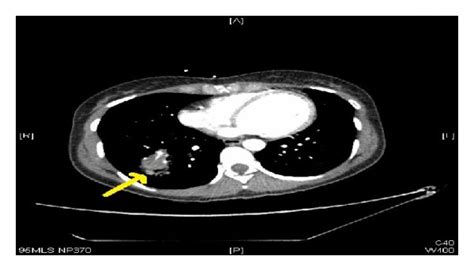 Ct Scan With Contrast Showing A Right Lung Abscess The Most Likely