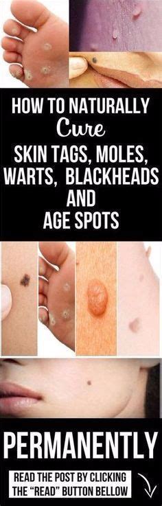 how to naturally cure skin tags moles warts blackheads and age spots natural cures