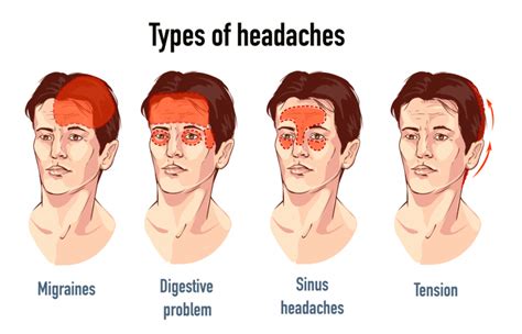 Headache Causes Symptoms Diagnosis Types And Treatment 2023