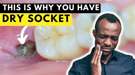All You Need To Know About Dry Socket Alveolar Osteitis How To