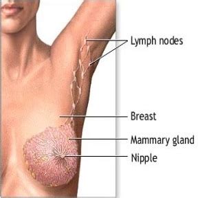 This stage may be diagnosed years after the initial cancer diagnosis and/or after the primary cancer has been treated or removed. Stage 1 Breast Cancer | Med-Health.net