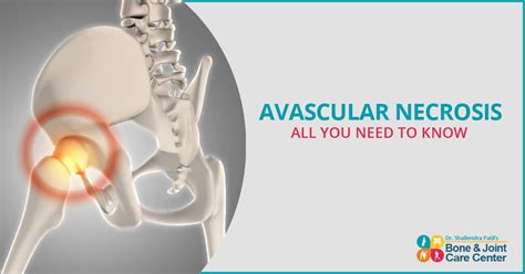 What Is Avascular Necrosis Causes Stages And Treatment Dr