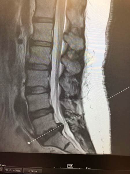 If you are working towards l5 s1 disc herniation recovery, you need to make sure that you are seeing progress. Lumbar Disc Herniation - Stechison Neurosurgery Atlanta, LLC