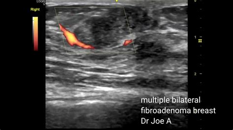Multiple Bilateral Fibroadenoma Breasts Young Female Ultrasound Video