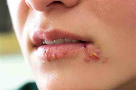How To Get Rid Of A Pimple On Lip Cause And Treatments Viewhealthy