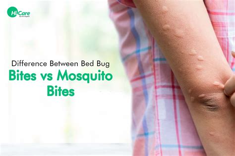 Difference Between Bed Bug Bites And Mosquito Bites Hicare
