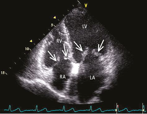 Figure 0316396 Transthoracic Echocardiography Tte Apical 4 Chamber