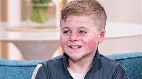 The Brave Boy Living With Rare Skin Disease Epidermolysis Bullosa