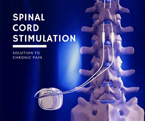 Spinal cord stimulation