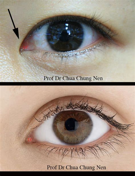 Eyelid Surgery By Prof Dr Cn Chua 蔡鐘能 Doc Do I Need Operation On My