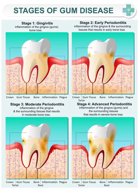 Infographic Stages Of Gum Disease Welcome To Dr Arman Torbati S Dental Blog Los Angeles