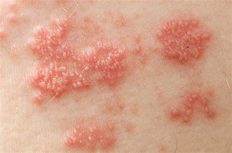 Shingles Rash Stock Photos Pictures And Royalty Free Images Istock