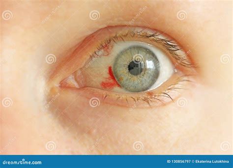 Bloodshot Eye Woman With Burst Blood Vessel In Eye Stock Image Image