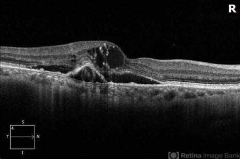 Neovascular Amd With Ring Shaped Lesions Retina Image Bank