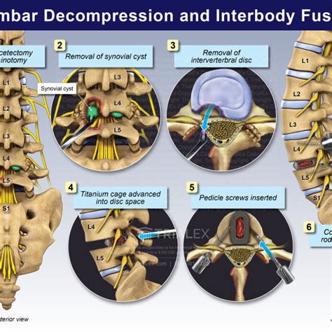 Lumbar Decompression And Interbody Fusion Trialexhibits Inc