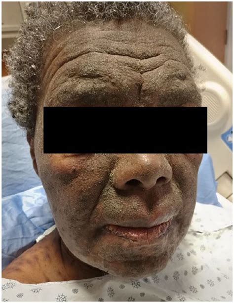 The Patients Face Was Diffusely Infiltrated With Scaly Verrucous