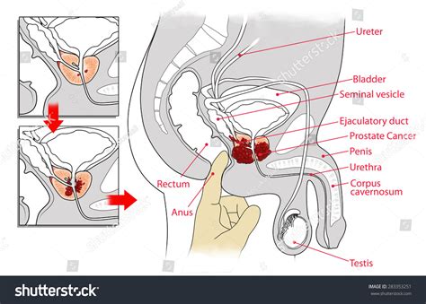 Manual Examination Crosssectional View Prostate Cancer Stock