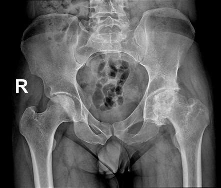 Avascular Necrosis Of The Hip Radiology Reference Article