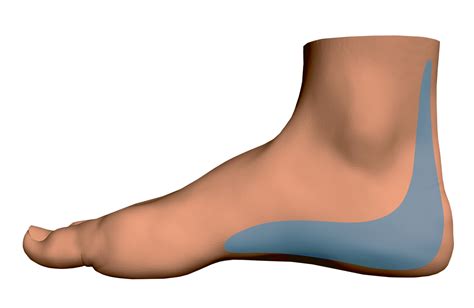 Heel Pain In Beachwood Oh Erie Foot And Ankle Center