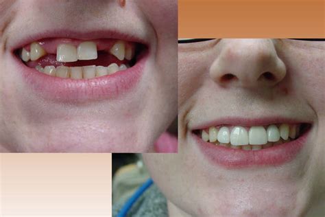 Keystone Mini Dental Implant Center Will Make You Smile