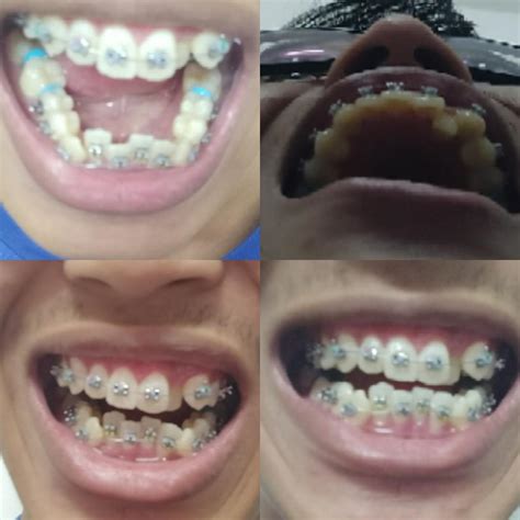 The question of the effectiveness sparing techniques already in anybody. My ortho said my teeth can be fixed without any extraction. : braces