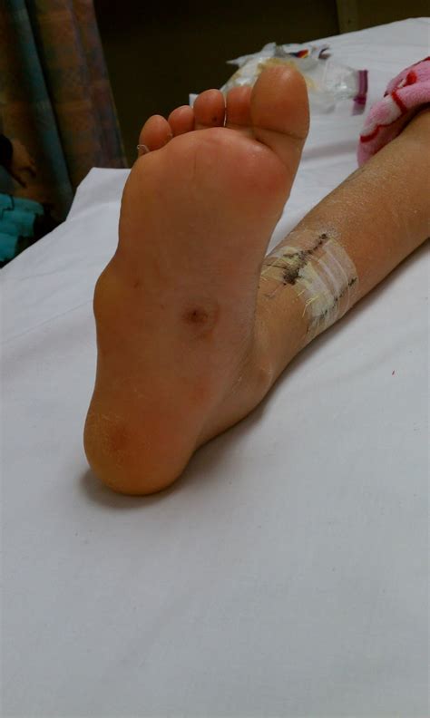 I injured the side of my foot when it hit concrete and it swelled the area is now a knot and looks deformed and the swelling never completely left and it's been 8 weeks. Faith, Hope, Joy, and Grace!!: Cast off, Cast on