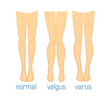 Perna Torta Para Trás