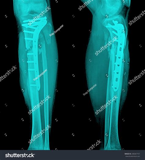 Film Leg Aplateral Show Fracture Shaft Stock Photo 248367757 Shutterstock