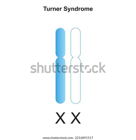 Scientific Designing Turner Syndrome Monosomy X Stock Vector Royalty
