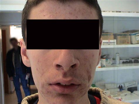 Diseases Of The Sebaceous Glands Acne Cystic Picture Hellenic