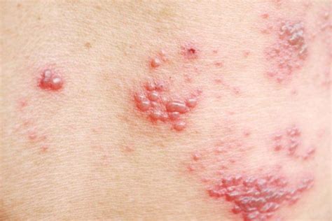 How To Cure Shingles In 3 Days Relieve Pain And Get Rid Of Rash Fast