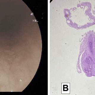 Esophageal Squamous Cell Papilloma Of Case A Download Scientific Diagram